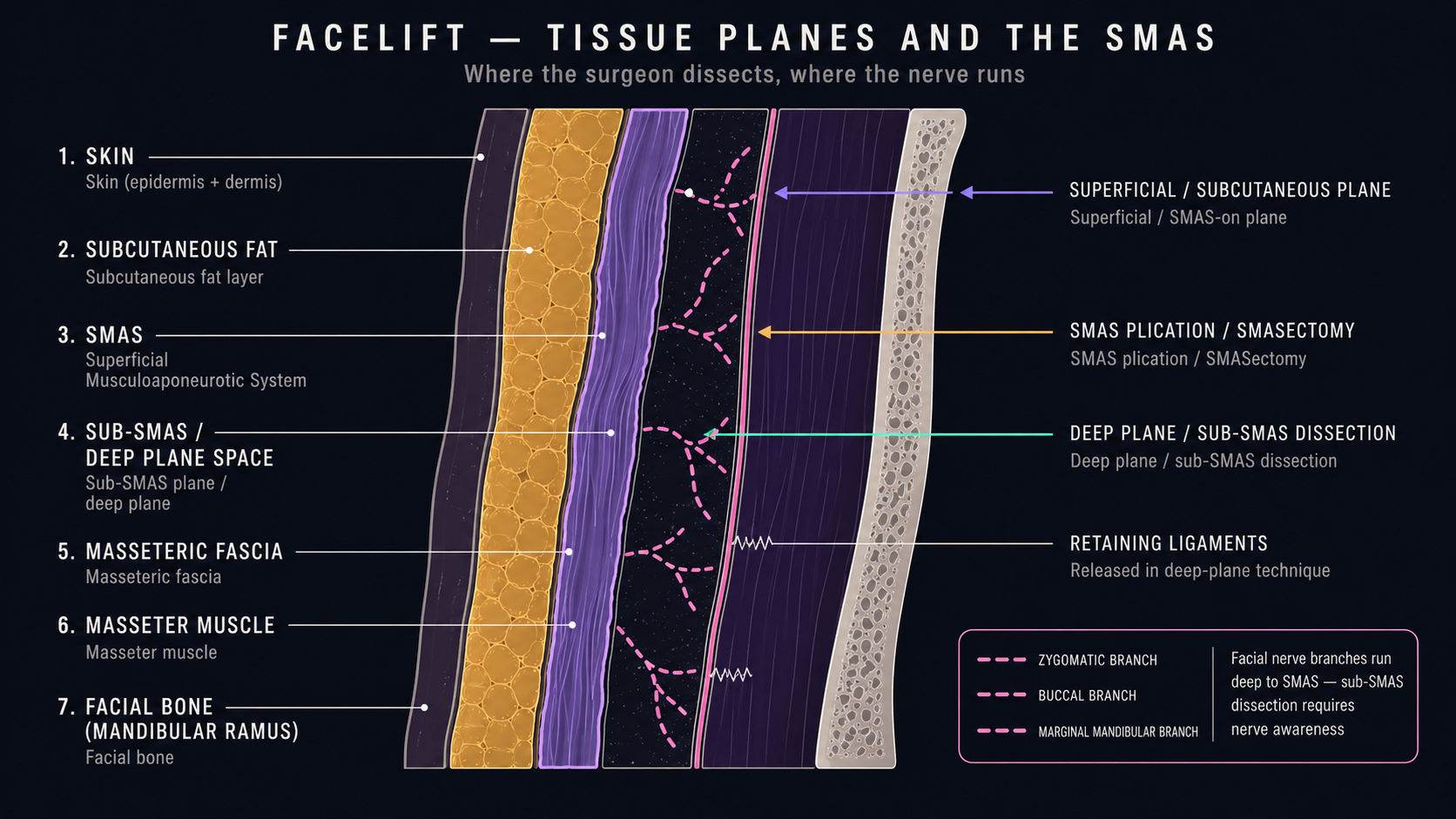 Cross-section through the lateral cheek showing skin, subcutaneous fat, SMAS, sub-SMAS deep plane, masseteric fascia, masseter, and bone, with the three facelift dissection planes (superficial, SMAS-on, deep-plane) and facial-nerve branches running deep to SMAS