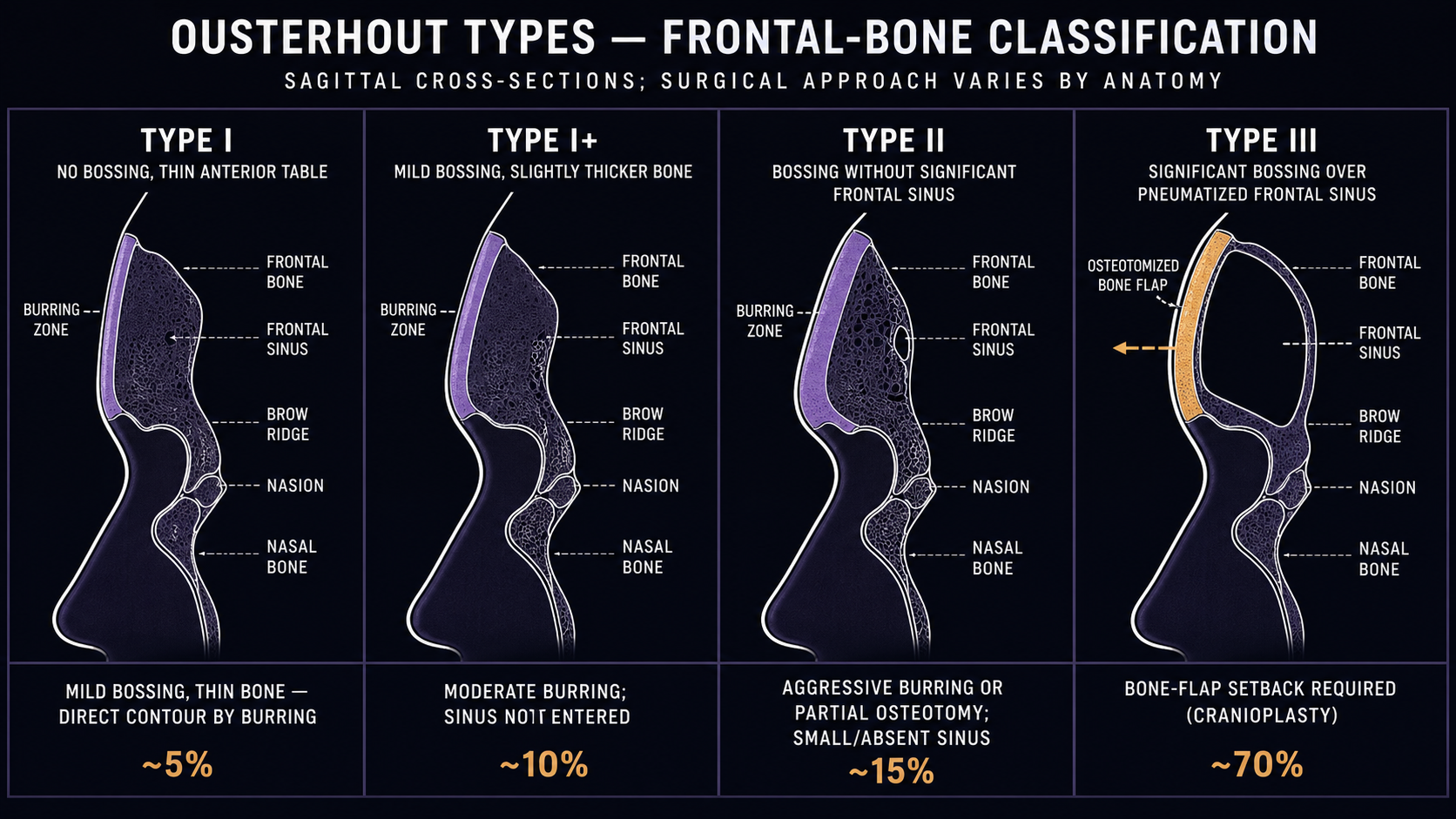 Four-panel sagittal cross-sections illustrating Ousterhout frontal-bone Types I, I+, II, and III, with frontal-sinus pneumatization, brow-bossing pattern, and recommended surgical approach (burring vs bone-flap setback) shown for each