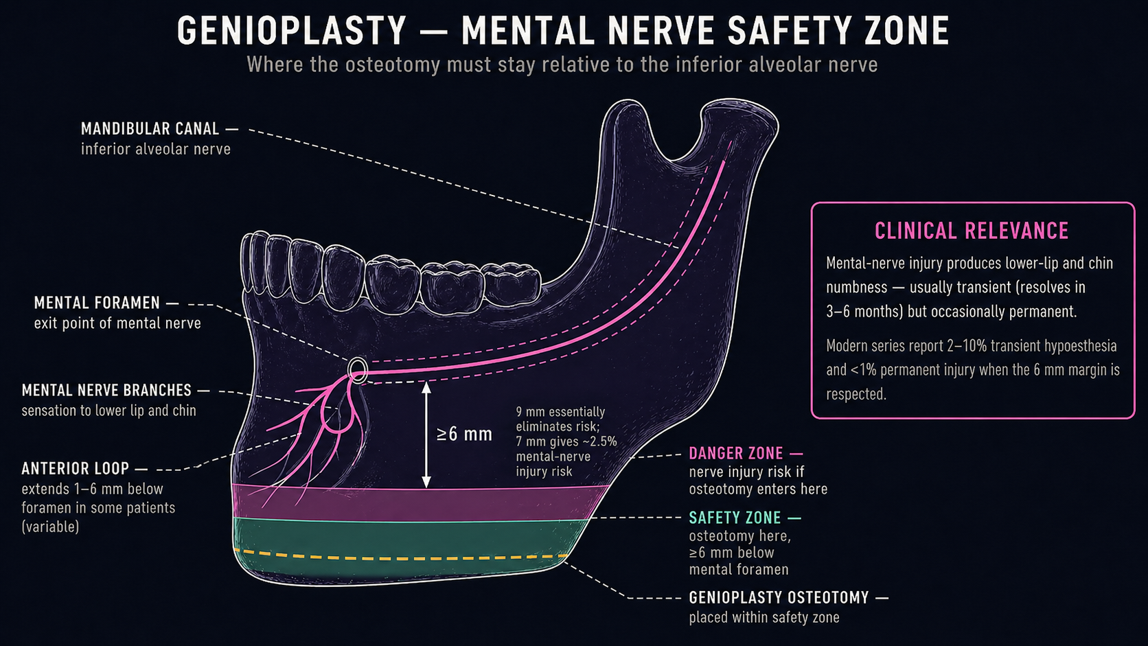 Oblique view of the lower mandible showing the mandibular canal, mental foramen with anterior nerve loop, mental-nerve branches to the lip and chin, and the mint safety zone vs hot-pink danger zone with the genioplasty osteotomy placed at least 6 mm below the foramen
