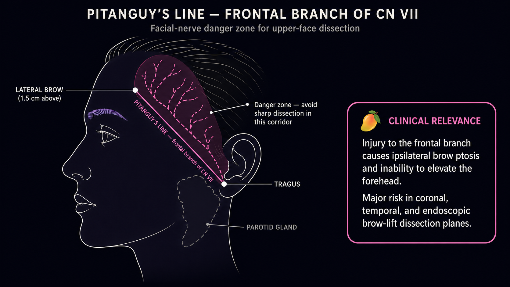 Lateral facial diagram showing the frontal branch of CN VII (facial nerve) coursing along Pitanguy's line from tragus to a point 1.5 cm above the lateral brow, with translucent danger-zone band and clinical-relevance callout