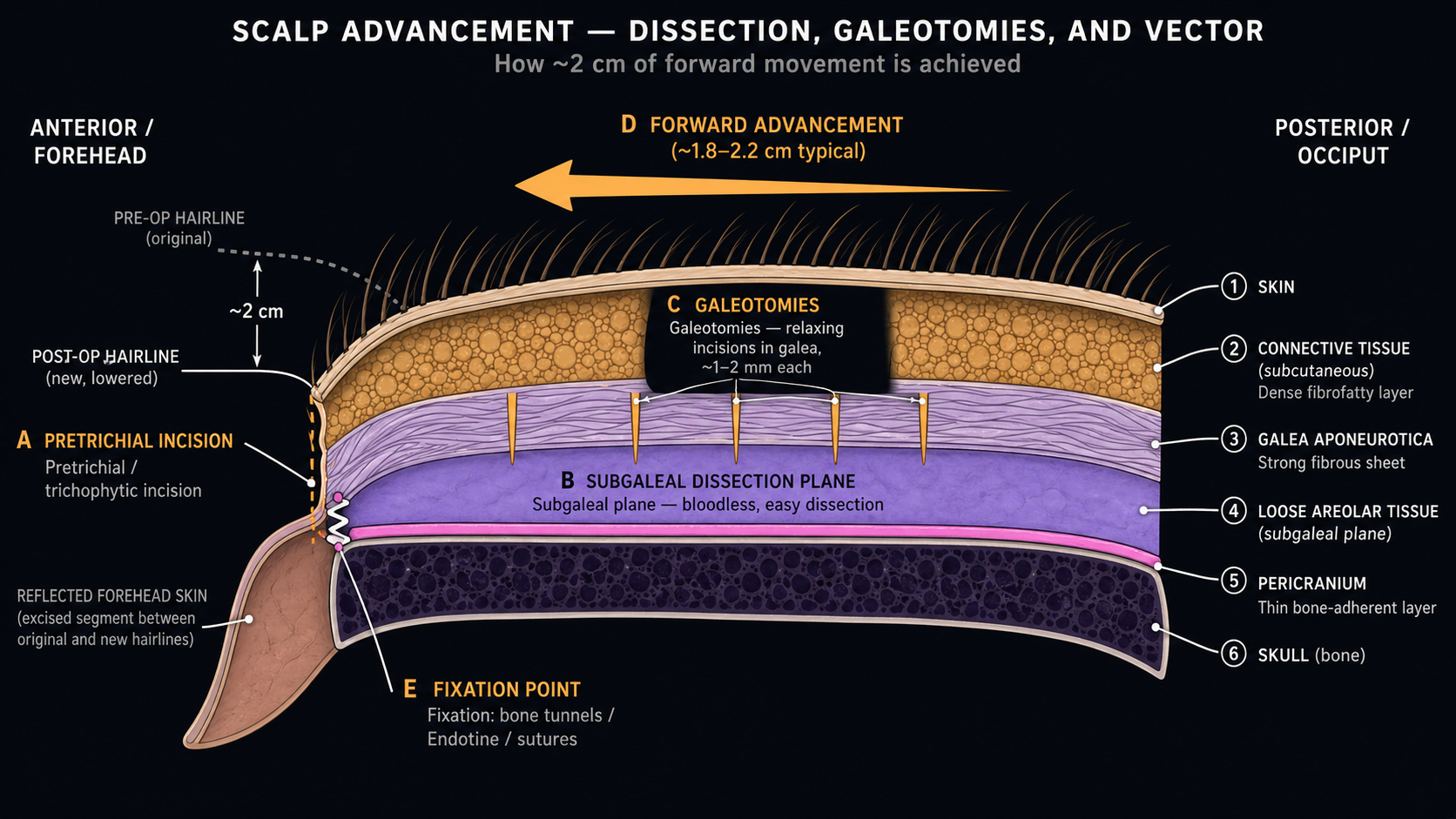 Sagittal cross-section of scalp advancement showing the layered scalp anatomy, subgaleal dissection plane, galeotomy relaxing incisions in the galea aponeurotica, and the ~1.8–2.2 cm forward advancement vector with pretrichial fixation