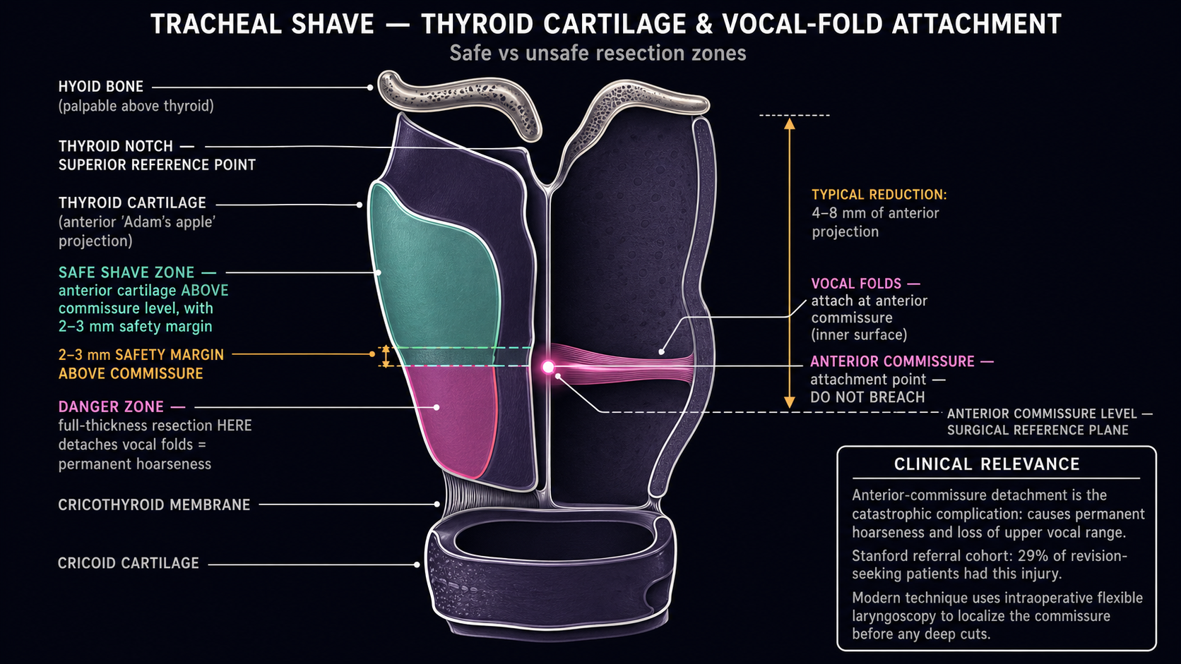 Sagittal cutaway of the thyroid cartilage showing vocal-fold attachment at the anterior commissure, mint safe-shave zone above the commissure with 2–3 mm margin, hot-pink danger zone at the commissure level, hyoid and cricoid landmarks, and a clinical-relevance callout noting the 29% commissure-detachment rate at non-laryngoscopy centers