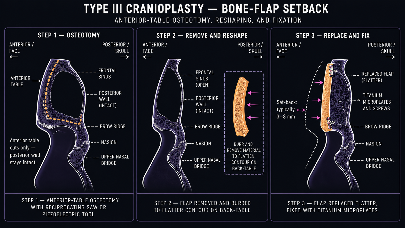 Three-step Type III cranioplasty diagram showing anterior-table osteotomy with cuts marked, the bone flap removed and burred flatter on a back-table, and the reshaped flap replaced with a 3–8 mm setback and fixed with titanium microplates