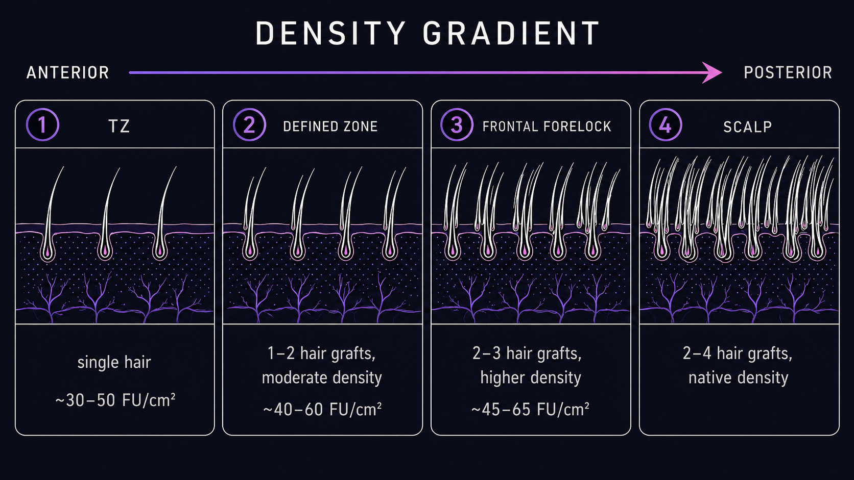 Density gradient diagram: four zones from anterior (transition zone, single-hair grafts at ~30–50 FU/cm²) through the defined zone, frontal forelock, and mid-scalp blend at native density