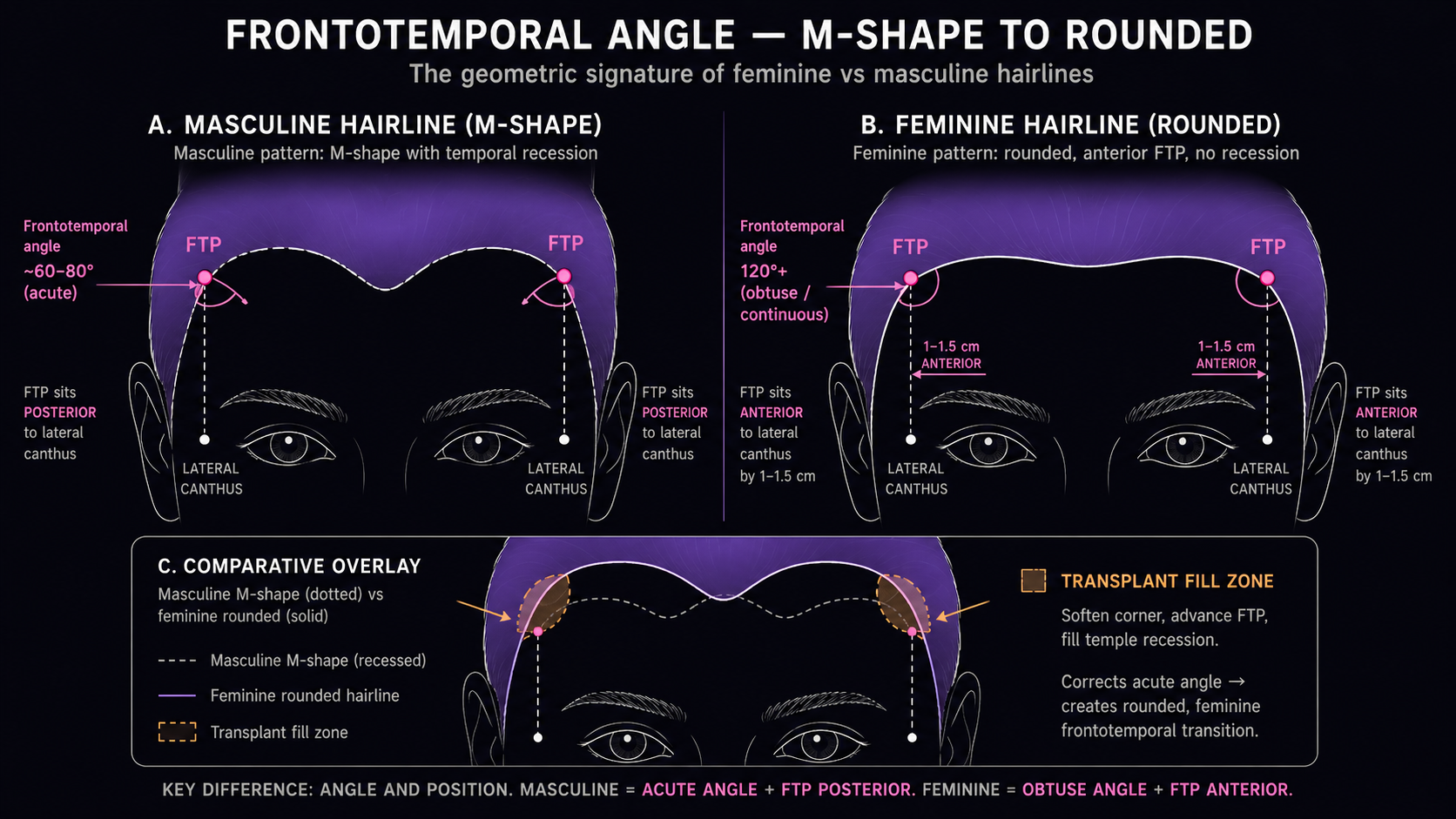 Three-panel comparison showing the masculine M-shape hairline with acute 60–80° frontotemporal angle and posteriorly placed FTP, the feminine rounded hairline with 120°+ continuous curve and anteriorly placed FTP, plus an overlay panel marking the transplant fill zone needed to bridge masculine to feminine