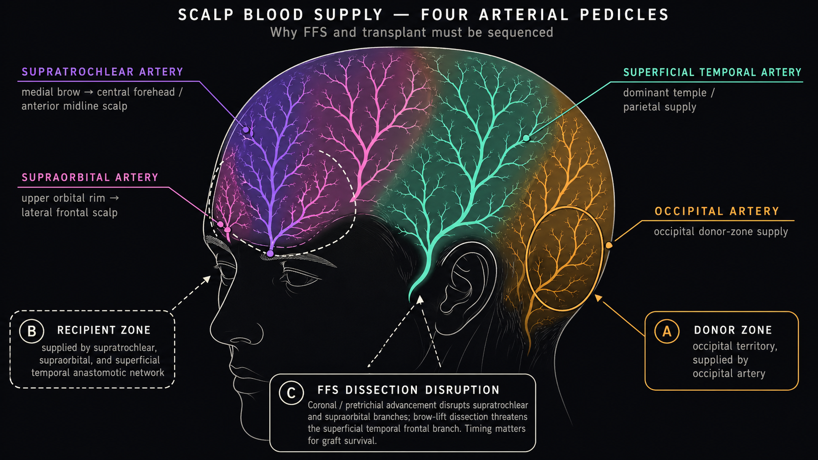 Lateral scalp diagram showing the four arterial pedicles (supratrochlear feeding central forehead, supraorbital feeding lateral frontal, superficial temporal feeding temple and parietal scalp, and occipital feeding the donor zone), with recipient and donor zones outlined and a callout on FFS-dissection disruption